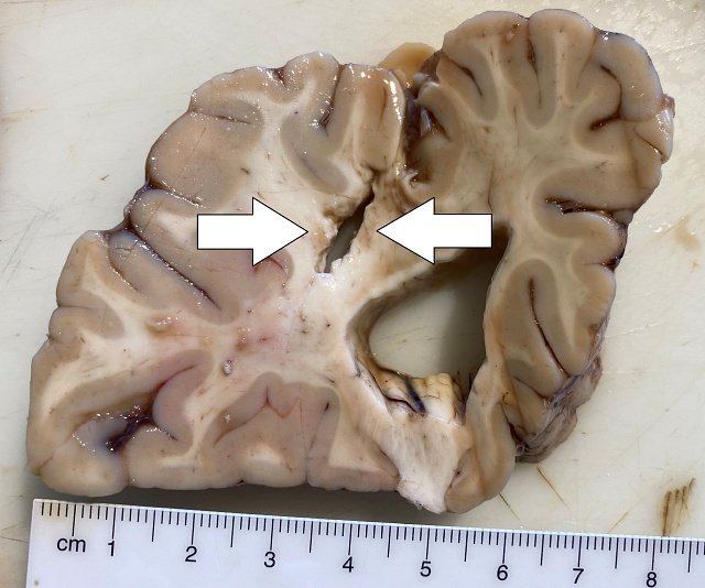 accidente-cerebrovascular-diabetes