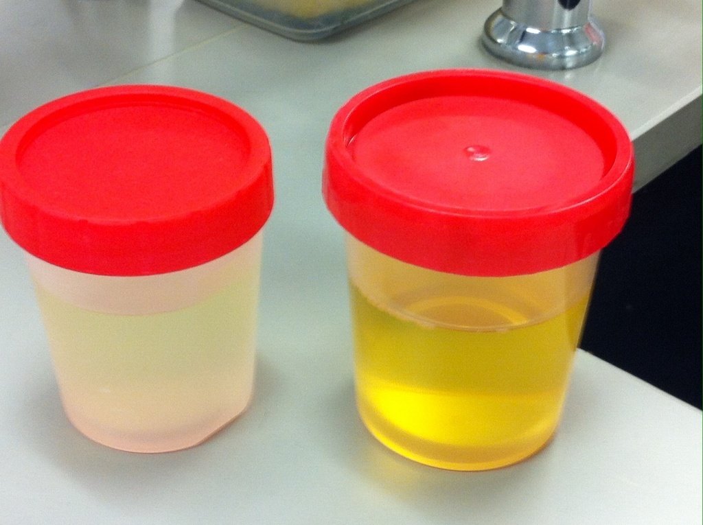 cetoacidosis-diabetica-test